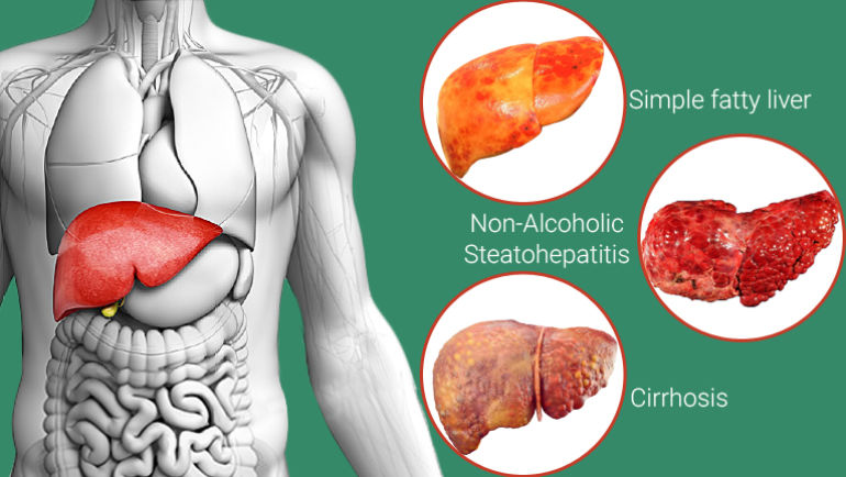 Non-Alcohol related fatty liver disease